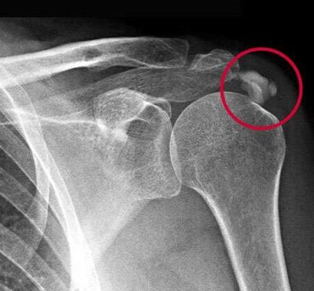 An X-ray showed deposits of calcium salts in the joint
