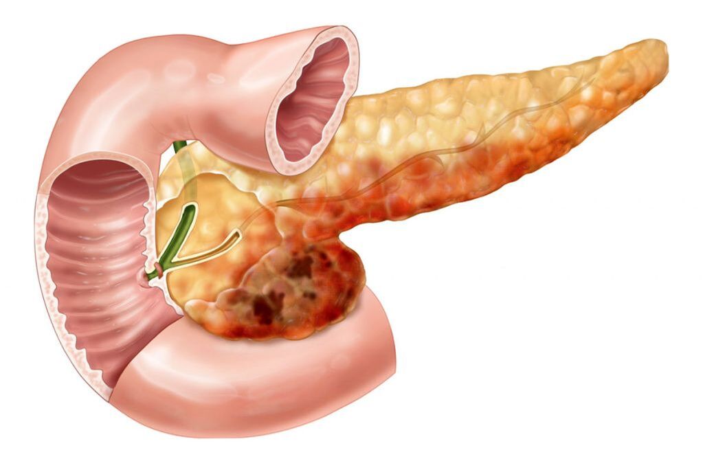back pain due to pancreatitis