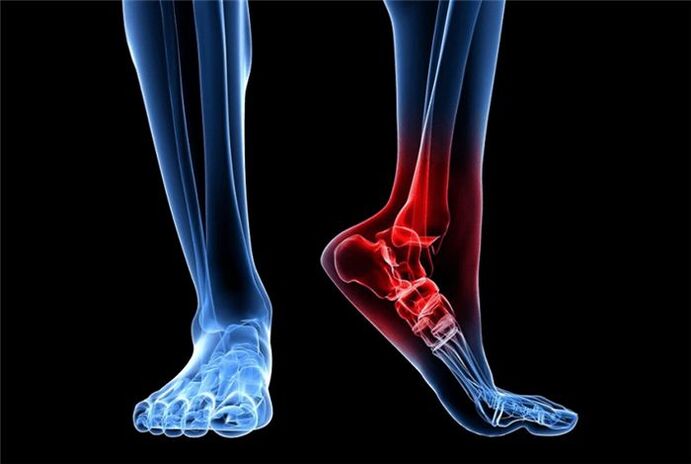 foot arthrosis