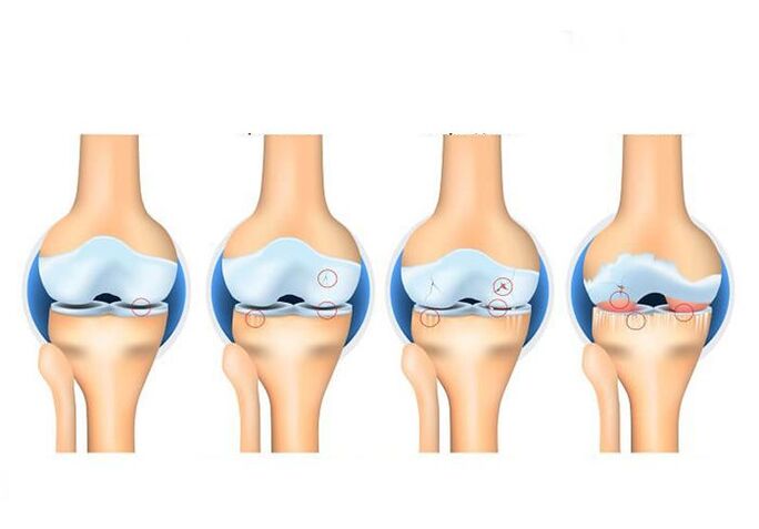 stage of arthrosis