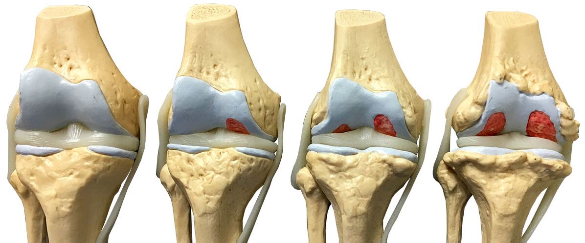 Phases of arthrosis knee joint