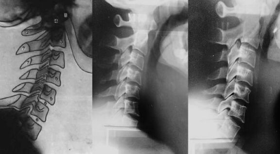 Neck with moving the first cervical royal