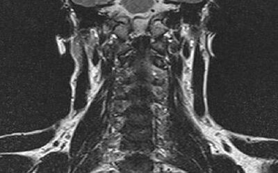 The spine of the cervix