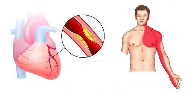 Cardian syndrome